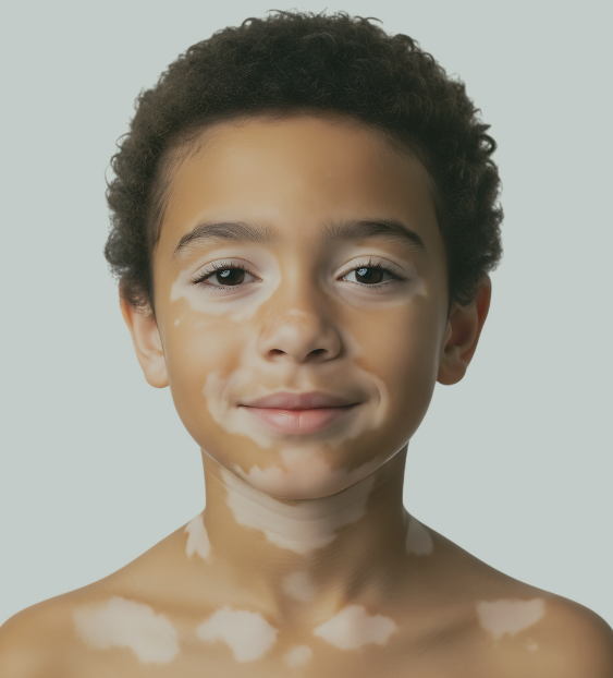 Vitiligo chez l’enfant : mieux comprendre, mieux accompagner