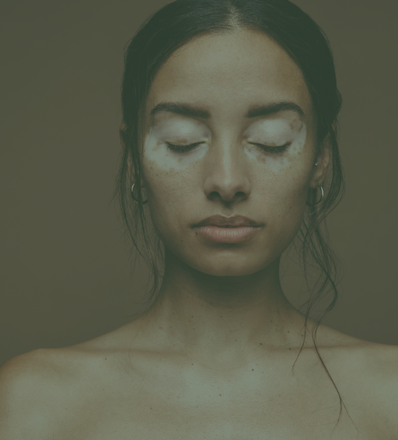 Vitiligo : causes et premiers signes de la dépigmentation